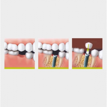 Dentální implantáty - foto č. 2